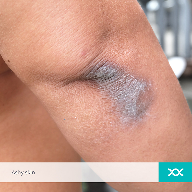 Ashy skin on the elbow