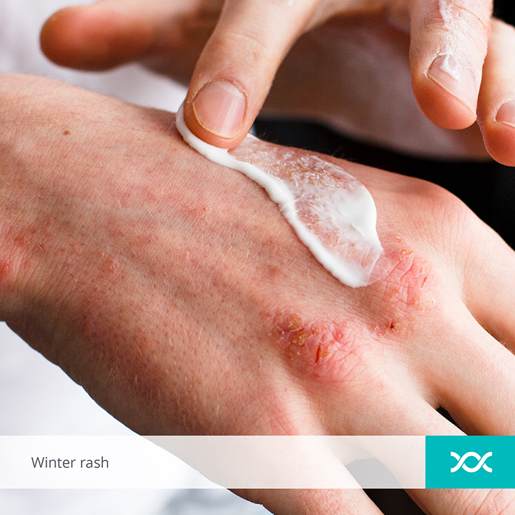 Putting lotion on hands with eczema scar